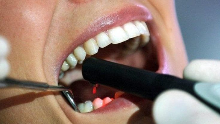 Melanoma gengivale, come si manifesta: rarissimo ma molto aggressivo