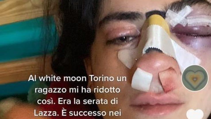 “In discoteca ho difeso il mio ragazzo e mi hanno colpita con un pugno in faccia”