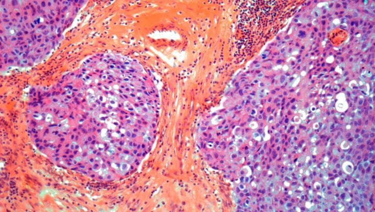 Tumore al seno: meno ricadute e aumento della sopravvivenza con terapia combinata
