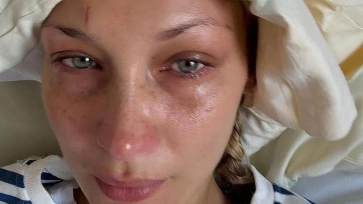 Bella Hadid posta delle foto dall’ospedale dove è ricoverata per la malattia di Lyme