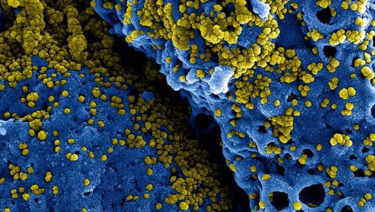 Covid-19: scoperti i cinque geni delle forme più gravi