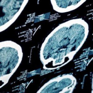 Scoperto il meccanismo di crescita del tumore al cervello