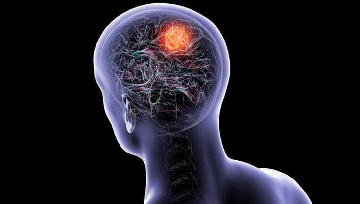Glioblastoma, nei maschi il testosterone sembra rallentare la malattia