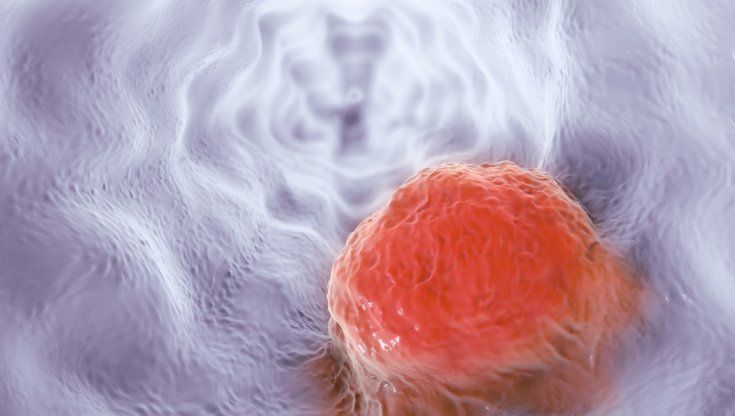 Tumore dell’esofago, buoni risultati per una nuova combinazione di immunoterapie