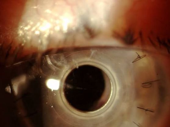 Staminali per riparare la cornea: italiano il primo farmaco al mondo
