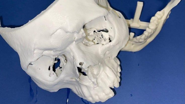 Un viso nuovo a un ragazzo di 23 anni grazie al cranio ricostruito in 3D: intervento da record al Cto