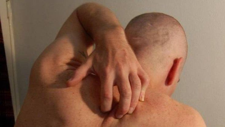 Orticaria, perché è difficile capire le cause