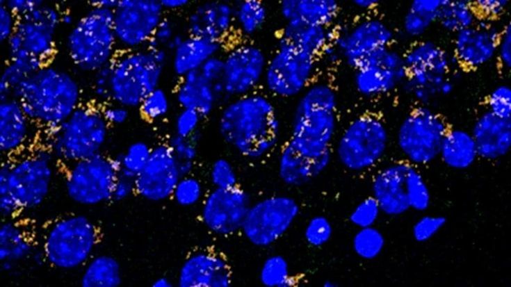 I traumi cranici potrebbero aumentare il rischio Alzheimer