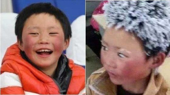 'Ice Boy' torna a sorridere: la nuova vita del bambino con i capelli di ghiaccio