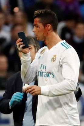 Real Madrid, taglio al viso per Cristiano Ronaldo: ma lui non rinuncia al selfie