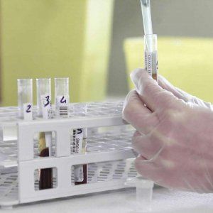 Tumore alle ovaie, test del sangue potrebbe ridurre le morti di un quinto