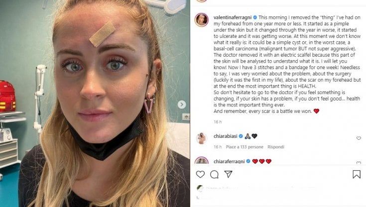 Tumori, basalioma confermato per Valentina Ferragni