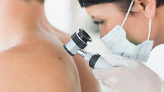 Melanoma: avanti tutta con l’immunoterapia