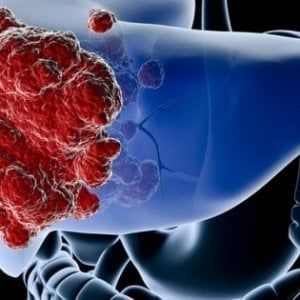 Tumore del colon: basta una chemioterapia più corta
