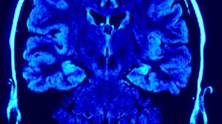L’attività fisica dimezza il rischio di Alzheimer