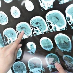 "Così mi sono salvata dall'ictus", la storia di Elisabetta e del suo ritorno alla vita