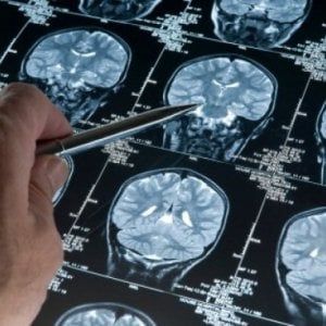 L’ictus raddoppia il rischio di demenza