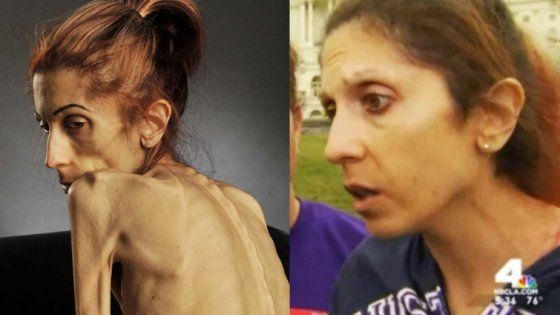 La storia di Rachael, salvata dal web: "Sto vincendo la mia battaglia contro l'anoressia"