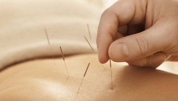 Contro l'obesità funziona anche l'agopuntura
