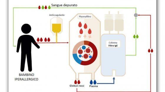 Salvato da allergia multipla con lavaggio sangue. Al "Bambino Gesù" il primo caso al mondo