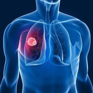Mesotelioma pleurico maligno: ‘doppietta’ di immunoterapici allunga sopravvivenza 