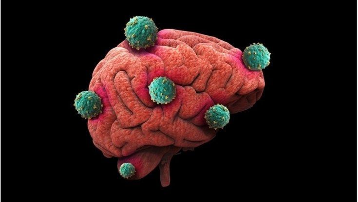 Glioblastoma, ricercatori Ieo scoprono come eliminare le cellule killer 