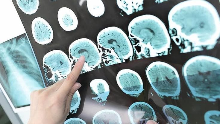 Ictus lacunare, così danneggia il cervello: come nasce e come prevenirlo
