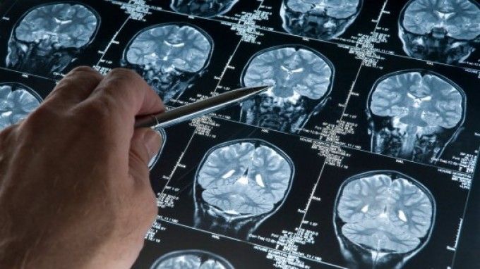 Ictus, 1 milione di casi in Italia. "Conoscere i sintomi per intervenire in tempo"