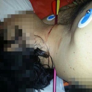 Miracolo a Torino: si presenta in ospedale con una freccia nel collo, salvato da intervento senza precedenti