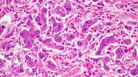 Tumore dello stomaco, nuove conferme per l'immunoterapia