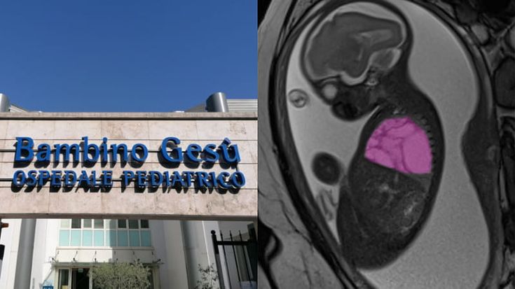 Feto con cisti gigante al polmone operato in utero: il bimbo è nato e sta bene