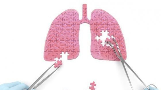 Tumore del polmone: lo screening salva la vita. Ancor più alle donne