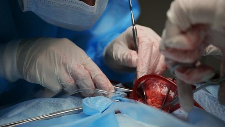 Doppio trapianto di cuore: operazione record a Torino