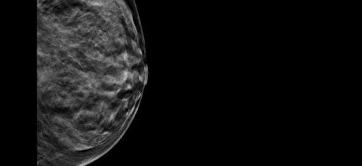 Seno, cambia la terapia per i tumori "in situ"