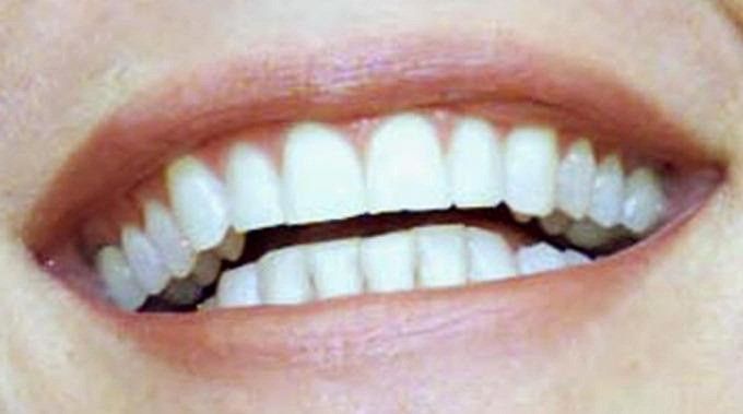Dentifrici abrasivi, quei "salva-denti" poco miracolosi