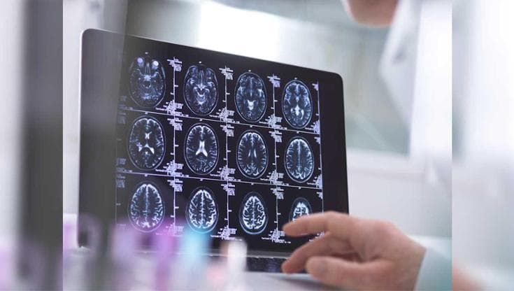 Ictus, ogni minuto muoiono due milioni di neuroni: perché il tempo è prezioso