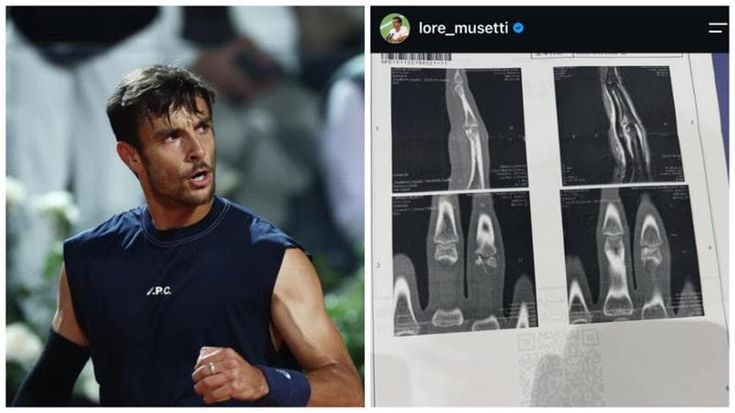 Lorenzo Musetti, frattura al dito: deve rinunciare anche a Tokyo