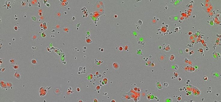 Tumore al seno: può formare cellule "dormienti" in risposta alle cure