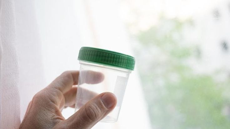 Tumore alla prostata, meno biopsie di controllo con un nuovo test sulle urine