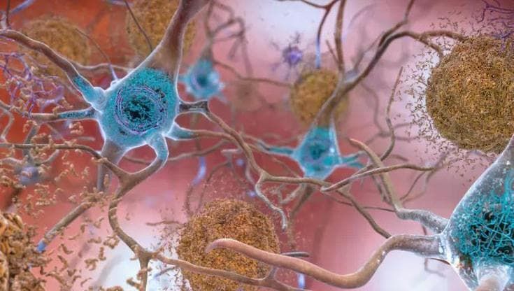 Alzheimer, i nuovi farmaci non fermano la malattia