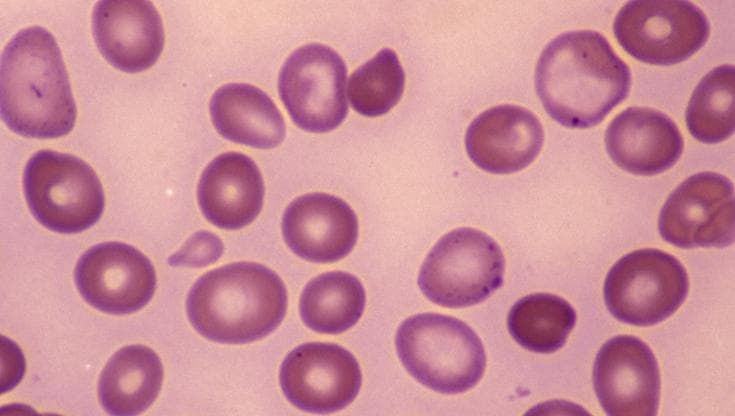 Anemia e Alzheimer, un legame scritto nel sangue