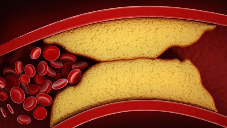 Colesterolo-LDL, se scende presto e bene cala di un terzo il rischio di infarto e ictus