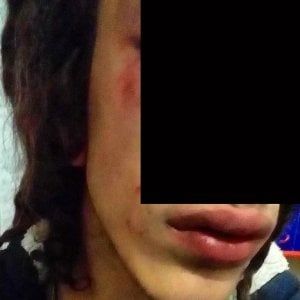 Omofobia, 17enne di Milano mostra i lividi su Facebook: "Insultato e preso a calci in faccia nel parco"