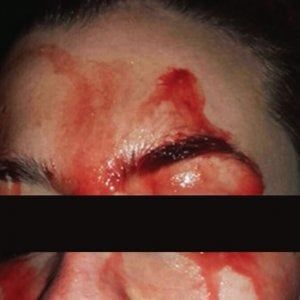 Lo strano caso della ragazza che sanguinava dal viso e dalle mani