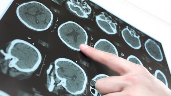 Parkinson, cellule cervello riprogrammate per combatterlo