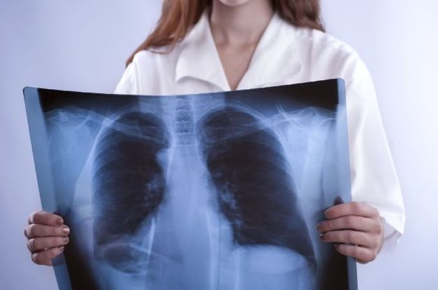 Tumore polmone, nuova immunoterapia dimezza la mortalità