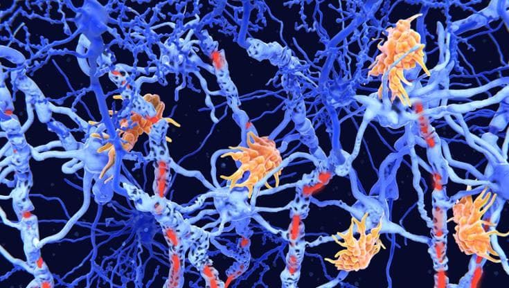 Sclerosi multipla: una diagnosi ogni tre ore. Una nuova strategia per aiutare i pazienti