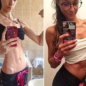 "Così mi sono salvata dall'anoressia": la storia di Silvia, studentessa di Padova