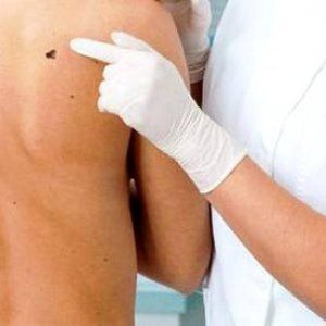 Melanoma, studio: "Nuove speranze da mix farmaci immunoterapici"