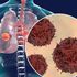 Tumore al polmone con mutazione HER2: nuova possibile opzione terapeutica in prima linea